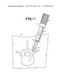 SPINAL FIXATION TOOL ATTACHMENT STRUCTURE diagram and image