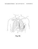 SYSTEMS AND METHODS FOR LEADLESS CARDIAC RESYNCHRINIZATION THERAPY diagram and image