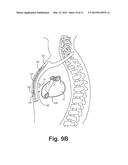 SYSTEMS AND METHODS FOR LEADLESS CARDIAC RESYNCHRINIZATION THERAPY diagram and image