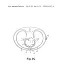 SYSTEMS AND METHODS FOR LEADLESS CARDIAC RESYNCHRINIZATION THERAPY diagram and image