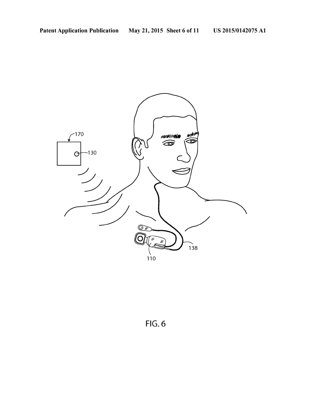 Sleep Apnea Control Device - diagram, schematic, and image 07