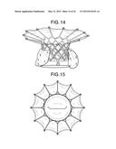 MULTI-COMPONENT DESIGNS FOR HEART VALVE RETRIEVAL DEVICE, SEALING     STRUCTURES AND STENT ASSEMBLY diagram and image