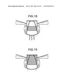 MULTI-COMPONENT DESIGNS FOR HEART VALVE RETRIEVAL DEVICE, SEALING     STRUCTURES AND STENT ASSEMBLY diagram and image