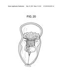 MULTI-COMPONENT DESIGNS FOR HEART VALVE RETRIEVAL DEVICE, SEALING     STRUCTURES AND STENT ASSEMBLY diagram and image