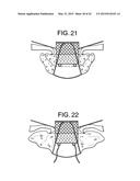 MULTI-COMPONENT DESIGNS FOR HEART VALVE RETRIEVAL DEVICE, SEALING     STRUCTURES AND STENT ASSEMBLY diagram and image
