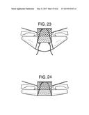 MULTI-COMPONENT DESIGNS FOR HEART VALVE RETRIEVAL DEVICE, SEALING     STRUCTURES AND STENT ASSEMBLY diagram and image