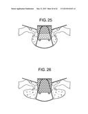 MULTI-COMPONENT DESIGNS FOR HEART VALVE RETRIEVAL DEVICE, SEALING     STRUCTURES AND STENT ASSEMBLY diagram and image