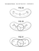 MULTI-COMPONENT DESIGNS FOR HEART VALVE RETRIEVAL DEVICE, SEALING     STRUCTURES AND STENT ASSEMBLY diagram and image