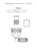 MULTI-COMPONENT DESIGNS FOR HEART VALVE RETRIEVAL DEVICE, SEALING     STRUCTURES AND STENT ASSEMBLY diagram and image