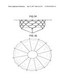 MULTI-COMPONENT DESIGNS FOR HEART VALVE RETRIEVAL DEVICE, SEALING     STRUCTURES AND STENT ASSEMBLY diagram and image