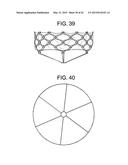 MULTI-COMPONENT DESIGNS FOR HEART VALVE RETRIEVAL DEVICE, SEALING     STRUCTURES AND STENT ASSEMBLY diagram and image