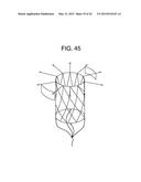 MULTI-COMPONENT DESIGNS FOR HEART VALVE RETRIEVAL DEVICE, SEALING     STRUCTURES AND STENT ASSEMBLY diagram and image