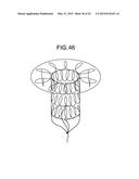 MULTI-COMPONENT DESIGNS FOR HEART VALVE RETRIEVAL DEVICE, SEALING     STRUCTURES AND STENT ASSEMBLY diagram and image