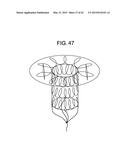 MULTI-COMPONENT DESIGNS FOR HEART VALVE RETRIEVAL DEVICE, SEALING     STRUCTURES AND STENT ASSEMBLY diagram and image