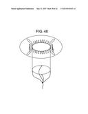 MULTI-COMPONENT DESIGNS FOR HEART VALVE RETRIEVAL DEVICE, SEALING     STRUCTURES AND STENT ASSEMBLY diagram and image