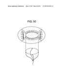 MULTI-COMPONENT DESIGNS FOR HEART VALVE RETRIEVAL DEVICE, SEALING     STRUCTURES AND STENT ASSEMBLY diagram and image