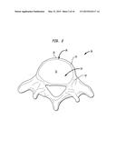 SPINAL IMPLANT APPARATUS AND METHODS diagram and image