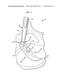 SPINAL IMPLANT APPARATUS AND METHODS diagram and image