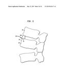 SPINAL IMPLANT APPARATUS AND METHODS diagram and image