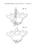 SPINAL IMPLANT APPARATUS AND METHODS diagram and image