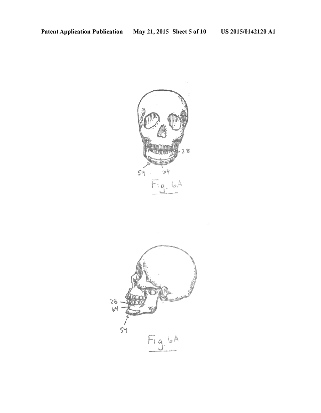 SYSTEM AND METHOD FOR TREATING OBSTRUCTIVE SLEEP APNEA - diagram, schematic, and image 06