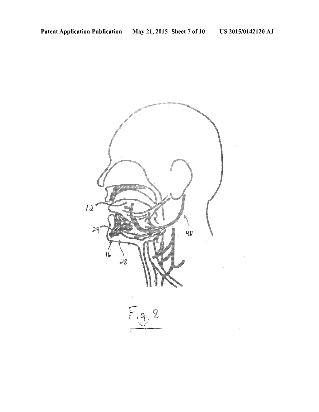 SYSTEM AND METHOD FOR TREATING OBSTRUCTIVE SLEEP APNEA - diagram, schematic, and image 08