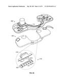 OPHTHALMIC SURGICAL SYSTEMS, METHODS, AND DEVICES diagram and image