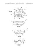 ONE VISIT DENTURE diagram and image