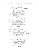 ONE VISIT DENTURE diagram and image