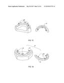 DENTAL BRIDGE ATTACHMENT SYSTEM AND METHOD diagram and image