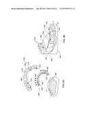 DENTAL BRIDGE ATTACHMENT SYSTEM AND METHOD diagram and image