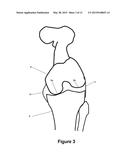 DETERMINING A RANGE OF MOTION OF AN ARTIFICIAL KNEE JOINT diagram and image