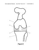 DETERMINING A RANGE OF MOTION OF AN ARTIFICIAL KNEE JOINT diagram and image