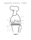 DETERMINING A RANGE OF MOTION OF AN ARTIFICIAL KNEE JOINT diagram and image