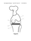DETERMINING A RANGE OF MOTION OF AN ARTIFICIAL KNEE JOINT diagram and image