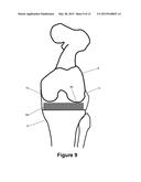 DETERMINING A RANGE OF MOTION OF AN ARTIFICIAL KNEE JOINT diagram and image