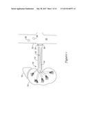 OSTIAL RENAL NERVE ABLATION diagram and image