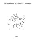 METHOD FOR FEMUR RESECTION ALIGNMENT APPROXIMATION IN HIP REPLACEMENT     PROCEDURES diagram and image