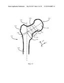 METHOD FOR FEMUR RESECTION ALIGNMENT APPROXIMATION IN HIP REPLACEMENT     PROCEDURES diagram and image