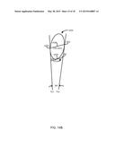 METHOD FOR FEMUR RESECTION ALIGNMENT APPROXIMATION IN HIP REPLACEMENT     PROCEDURES diagram and image