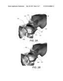 PATIENT-SPECIFIC ACETABULAR ALIGNMENT GUIDE AND METHOD diagram and image