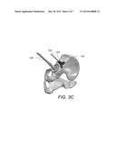 PATIENT-SPECIFIC ACETABULAR ALIGNMENT GUIDE AND METHOD diagram and image