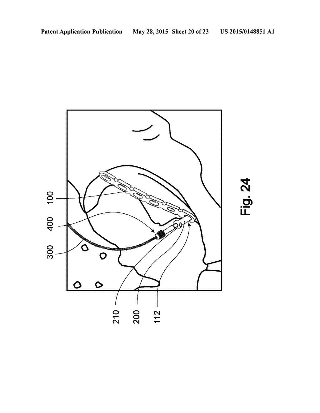 Devices, Systems, and Methods for Acetabulum Repair - diagram, schematic, and image 21