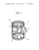 CARDIAC VALVE PROSTHESIS diagram and image