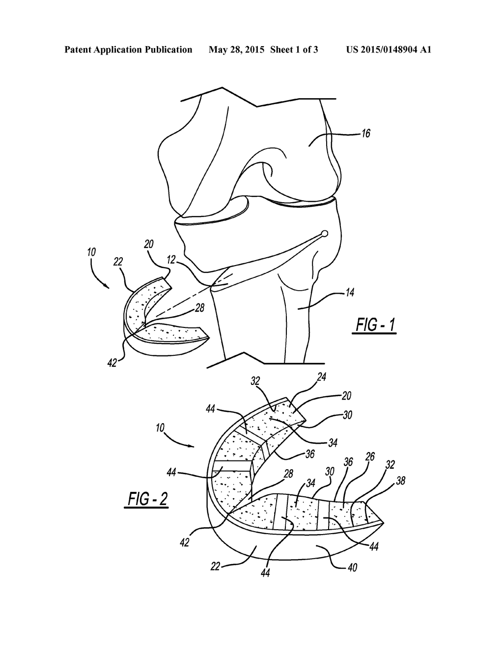 Method And Apparatus For Pre-Forming A High Tibial Osteotomy - diagram, schematic, and image 02