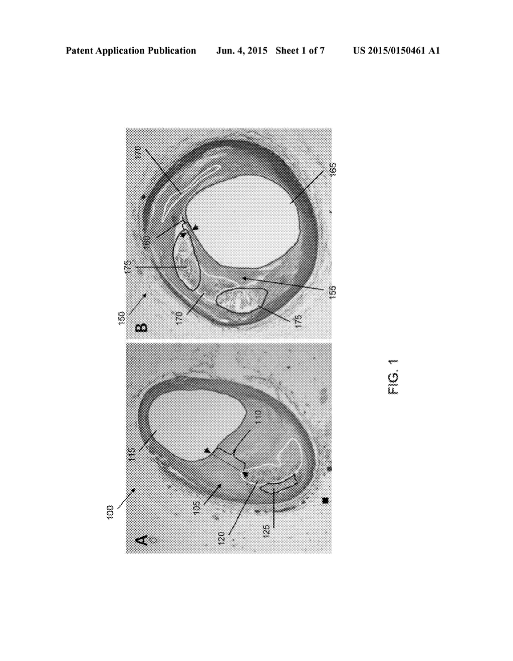 Detection of Lipid Core Plaque Cap Thickness - diagram, schematic, and image 02