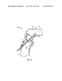 TISSUE GRAFT FIXATION diagram and image