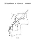 TISSUE GRAFT FIXATION diagram and image