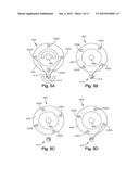 REMOTELY ADJUSTABLE TISSUE DISPLACEMENT DEVICE diagram and image