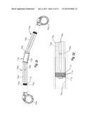 REMOTELY ADJUSTABLE TISSUE DISPLACEMENT DEVICE diagram and image